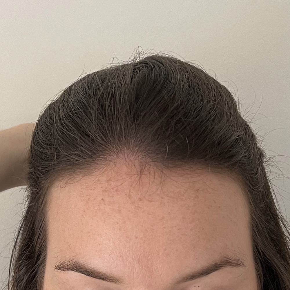 3.  Frontal hairline: