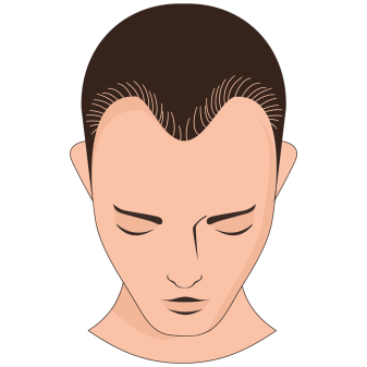 Receding hairline