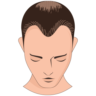 A thinning crown