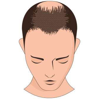 Overall thinning
